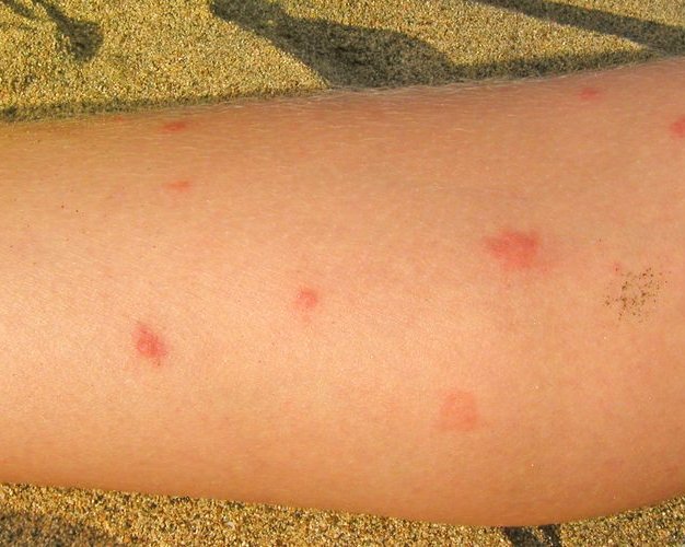 Что делать после укуса мошки, чтобы избежать осложнений